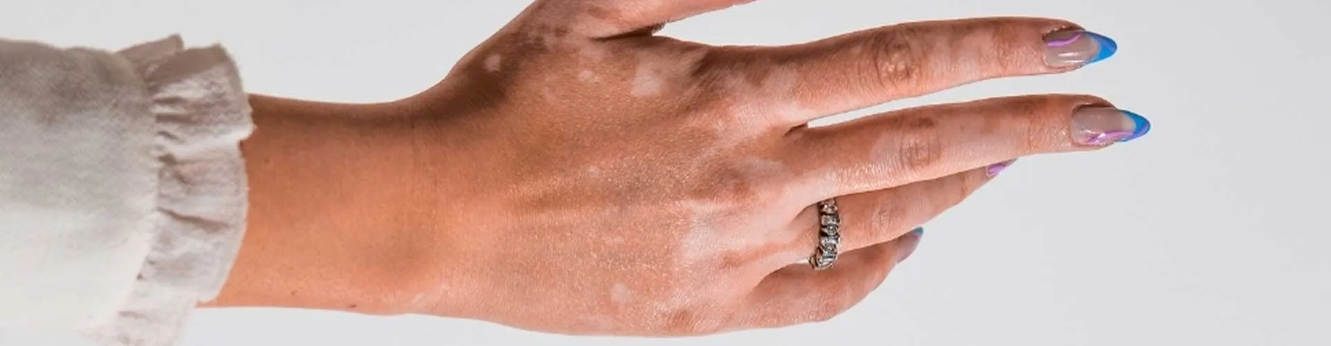 How to Recognize the Early Stage of Vitiligo