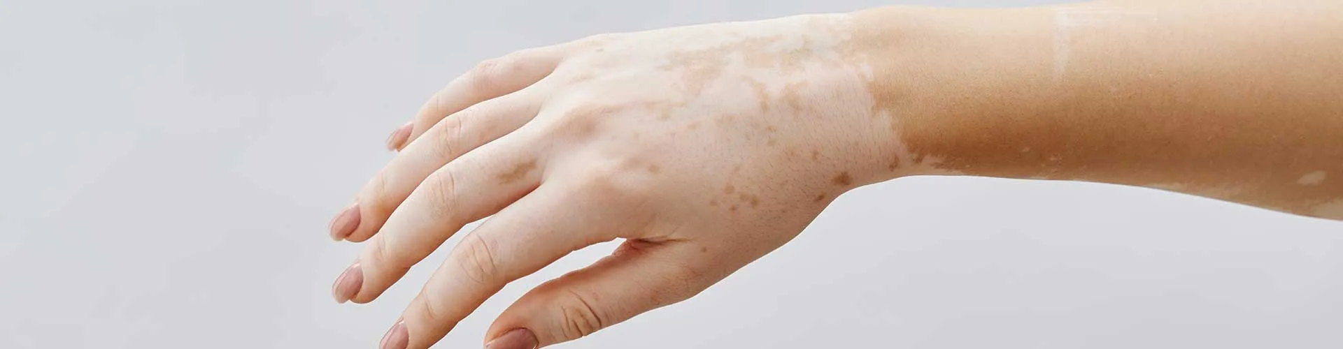 Could Skin Whitening Be a Sign of Vitiligo?