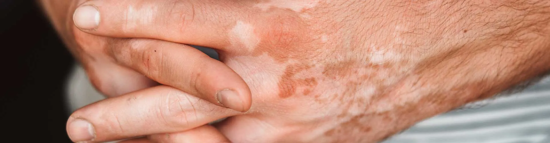 El ve Ayaklarda Vitiligo: Sebepler ve Tedavi Yolları