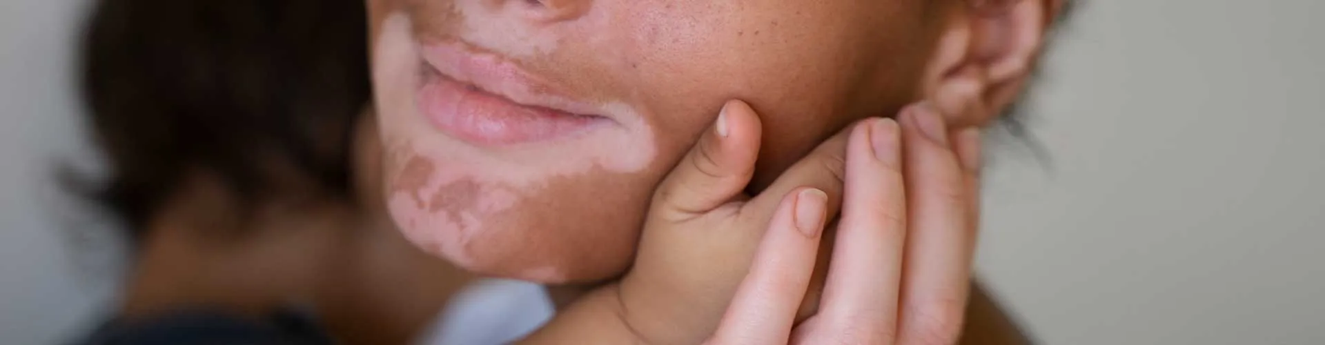 Vitiligo Genetik mi? Aileden Geçiş Olasılığı Hakkında Bilimsel Gerçekler