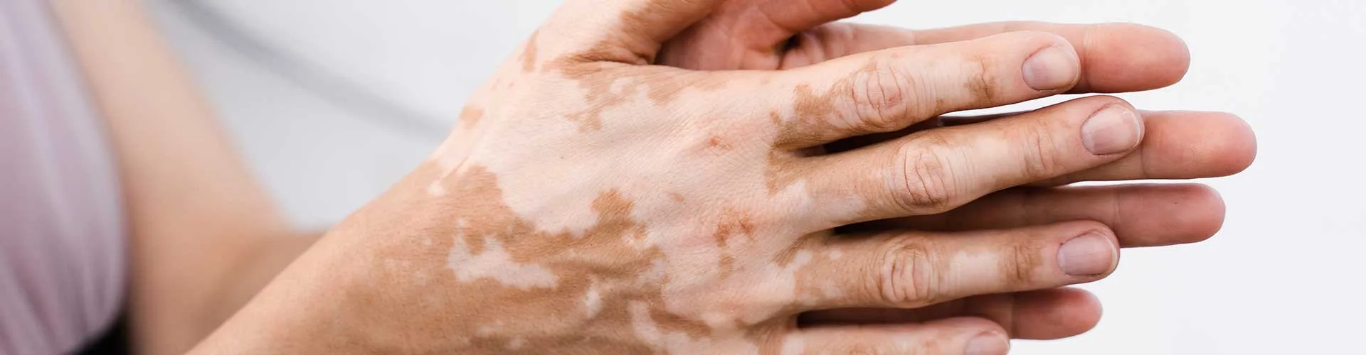 Vitiligo Hastaları İçin Beslenme Önerileri