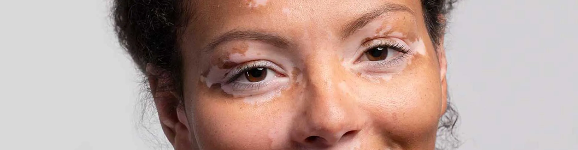 How Should Skin Care Be for Vitiligo Patients?