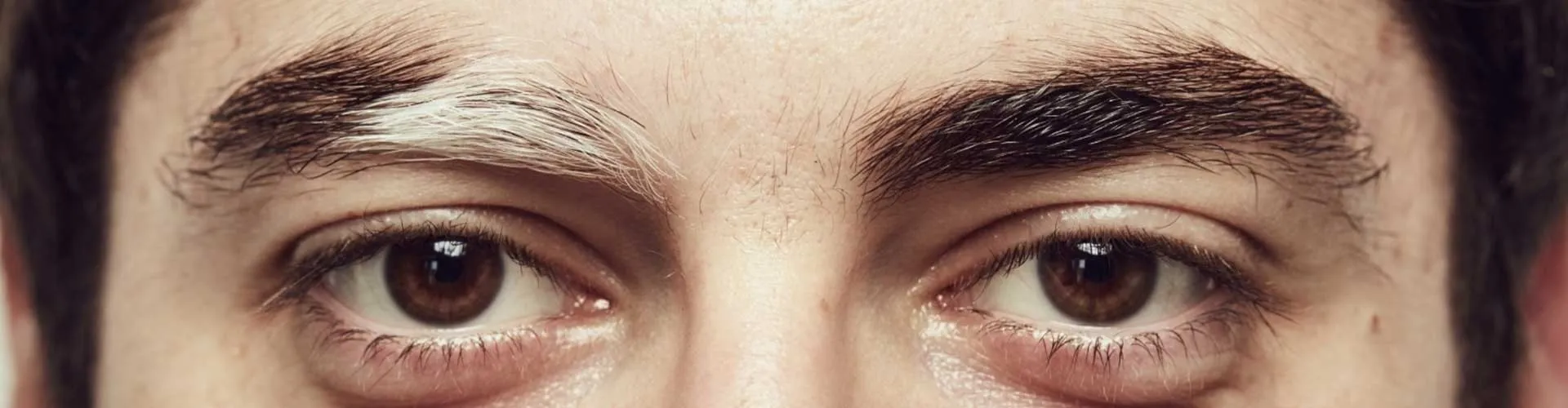 Hair and Eyebrow Whitening in Vitiligo Patients: Causes and Treatments
