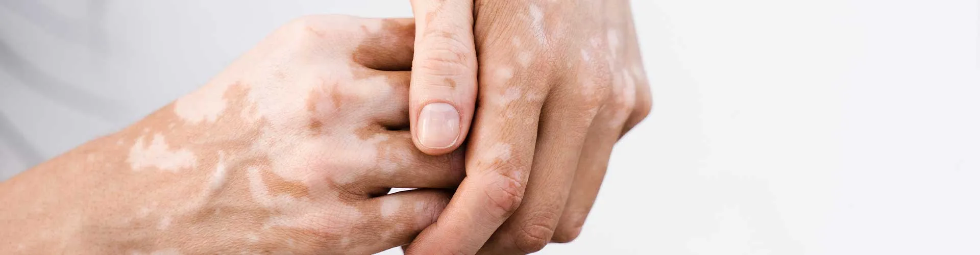 Vitiligo hastalığında bağışıklık sisteminin rolü nedir?
