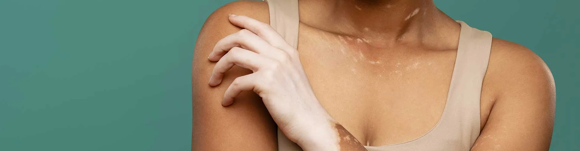 Vitiligo Hastalığında Pigment Hücrelerinin Rolü: Melanositler Nasıl Etkilenir?
