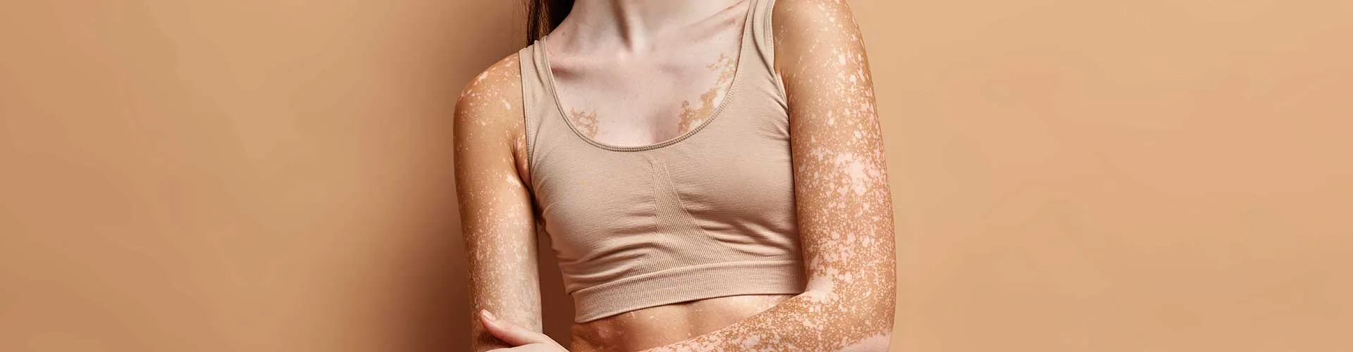 Vitiligo İçin En Etkili Lazer Tedavileri