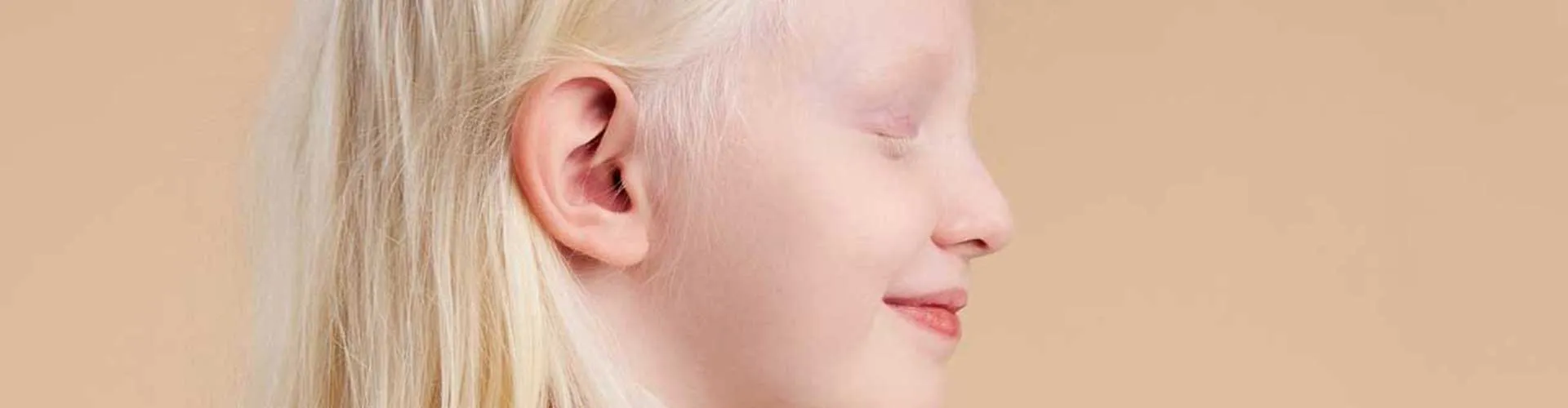 Vitiligo ile Albinizm Arasındaki Farklar: Klinik, Genetik ve Fonksiyonel Açılardan Derinlemesine İnceleme