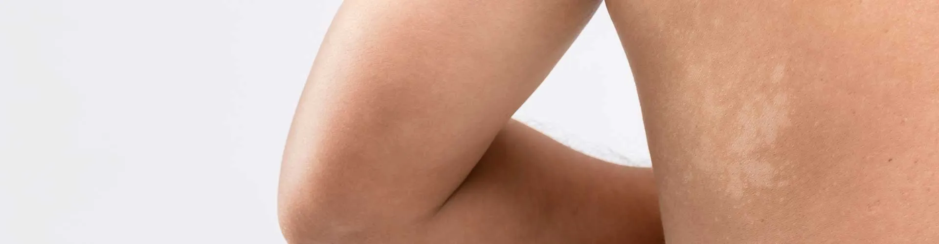 Which Conditions Can Be Confused with Vitiligo?