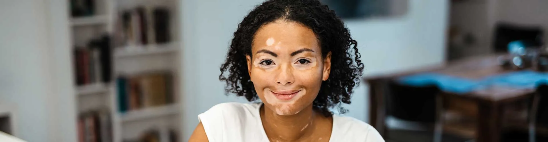 Vitiligo ile Yaşam: Kişisel Deneyimler ve Motivasyonlar