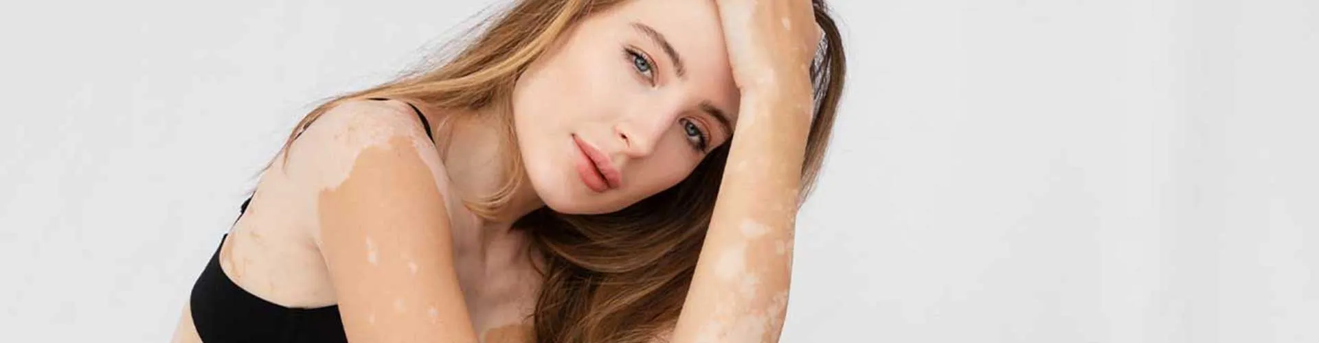 Does Vitiligo Progress? Disease Course and Methods to Control It