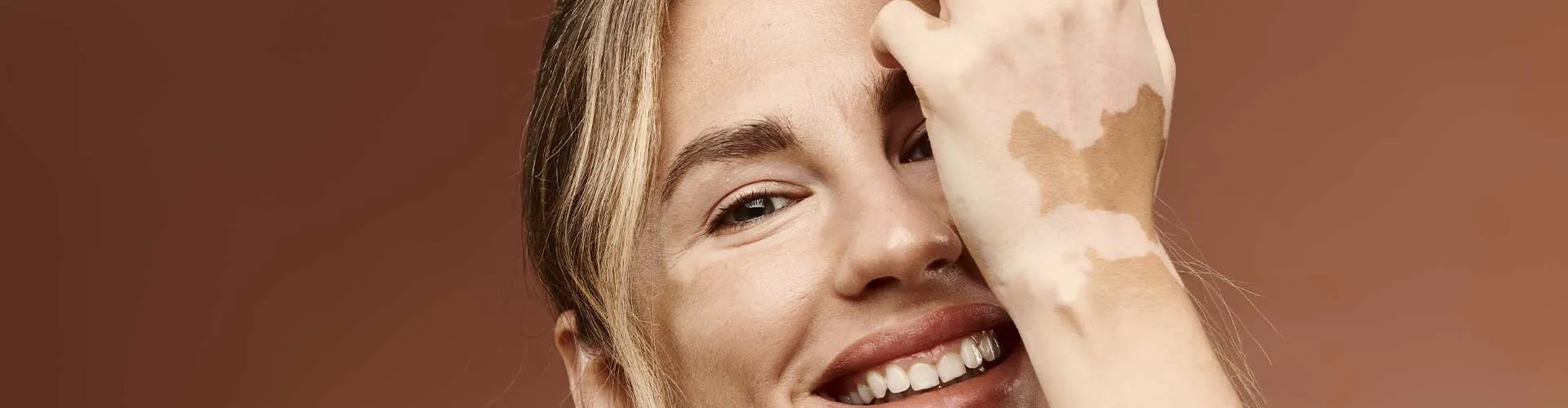 Vitiligo Lekeleri Kalıcı mıdır? Bilimsel Açıdan Değerlendirme