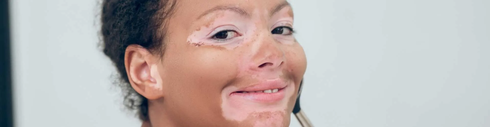 Vitiligo Lekeleri Makyajla Nasıl Kapatılır? Profesyonel Teknikler ve Ürün Önerileri