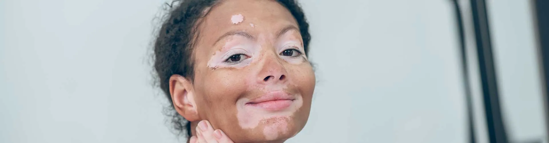How Is Vitiligo Diagnosed? Tests and Clinical Evaluation
