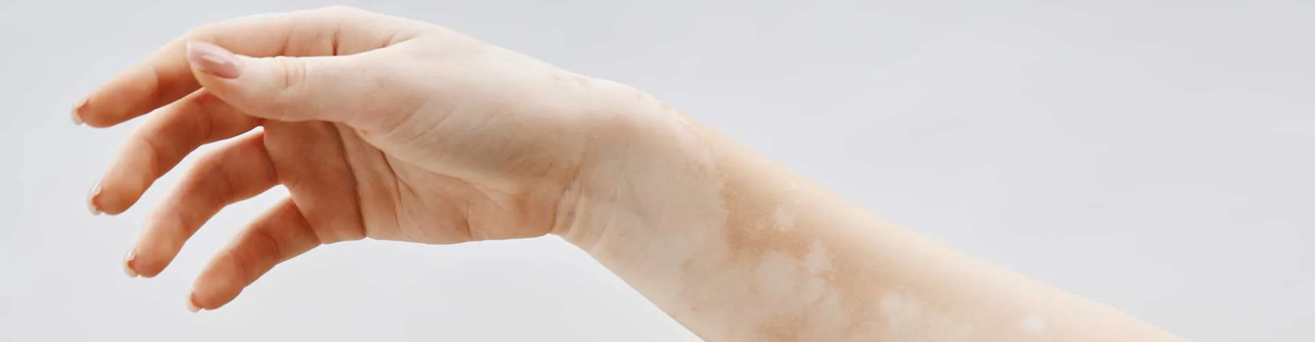 Vitiligo Tedavisinde En Güncel Yöntemler Nelerdir?