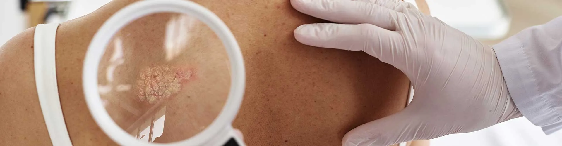 Vitiligo ve Deri Kanseri Riski Arasında Bağlantı Var mı?
