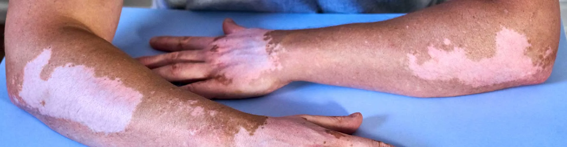 What Is the Relationship Between Vitiligo and Stress?