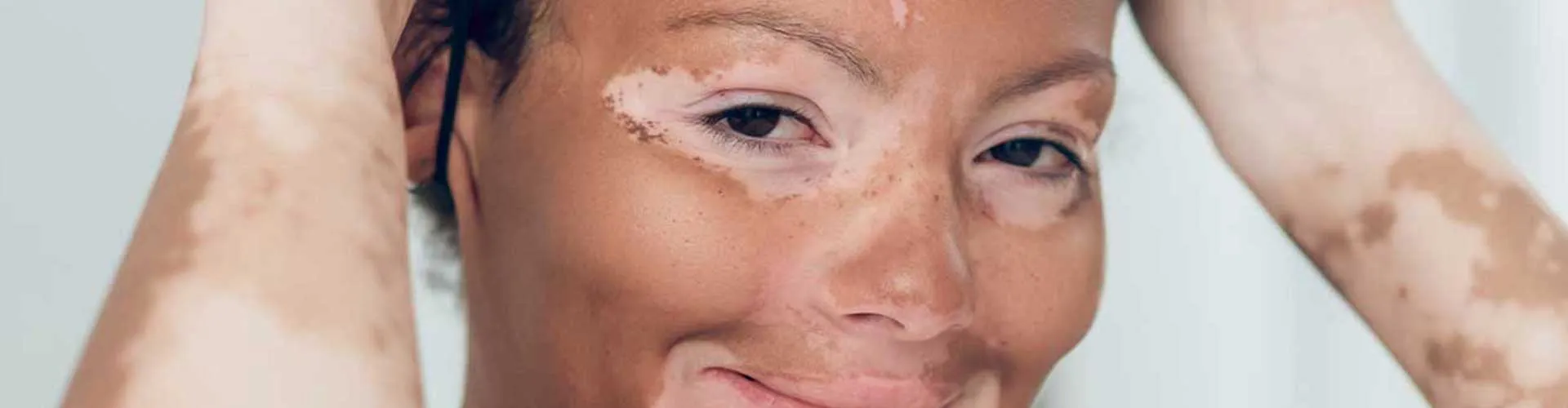 Common Body Areas Affected by Vitiligo