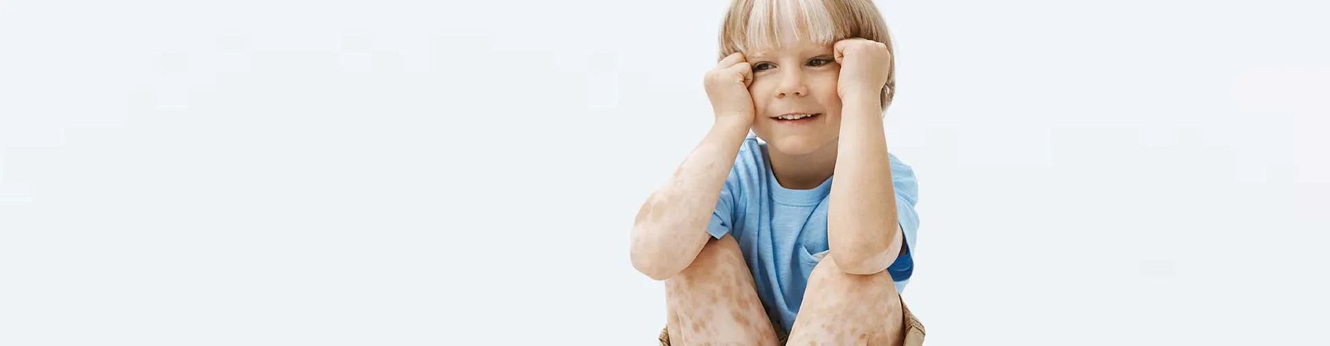 Vitiligo in Children: Symptoms and Management Strategies