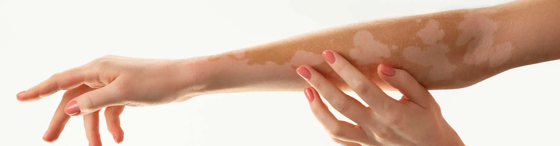 What is Vitiligo? Symptoms, Causes, and Treatment Options
