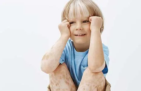 Vitiligo in Children: Symptoms and Management Strategies