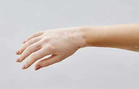 Could Skin Whitening Be a Sign of Vitiligo?