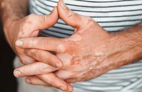 El ve Ayaklarda Vitiligo: Sebepler ve Tedavi Yolları
