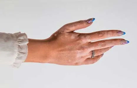 How to Recognize the Early Stage of Vitiligo