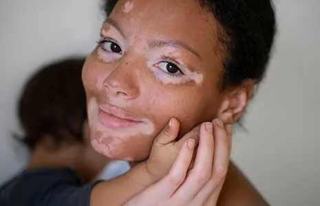 Is Vitiligo Genetic? Understanding Family Risk and Heredity
