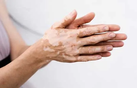 Vitiligo Hastaları İçin Beslenme Önerileri