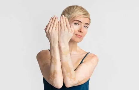 Vitiligo Hastaları İçin Yaz Mevsiminde Dikkat Edilmesi Gerekenler