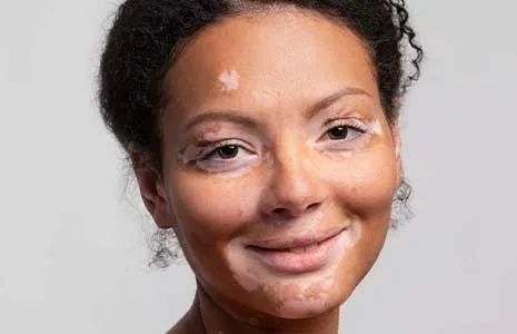 Vitiligo Hastalarında Cilt Bakımı Nasıl Olmalı?