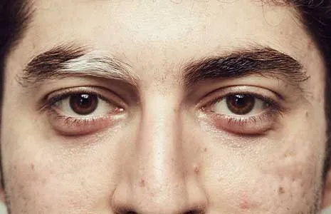 Hair and Eyebrow Whitening in Vitiligo Patients: Causes and Treatments