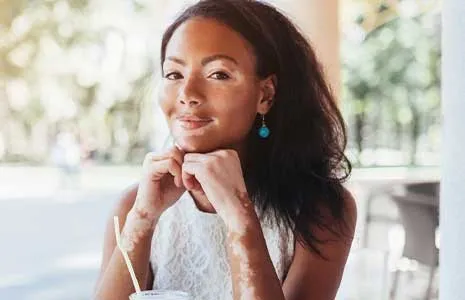 Vitiligo Hastalarının Sosyal Yaşamdaki Zorlukları