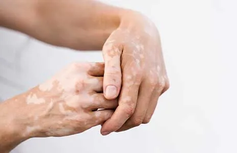 Vitiligo hastalığında bağışıklık sisteminin rolü nedir?