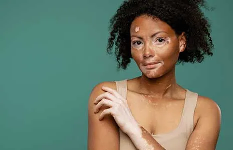 Vitiligo Hastalığında Pigment Hücrelerinin Rolü: Melanositler Nasıl Etkilenir?
