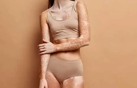Vitiligo İçin En Etkili Lazer Tedavileri