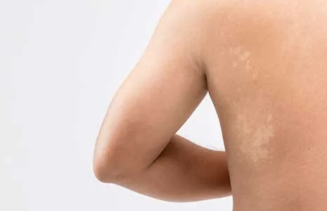 Which Conditions Can Be Confused with Vitiligo?