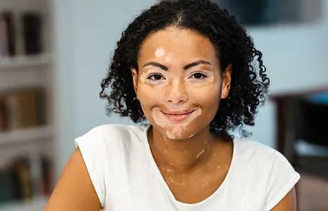Vitiligo ile Yaşam: Kişisel Deneyimler ve Motivasyonlar