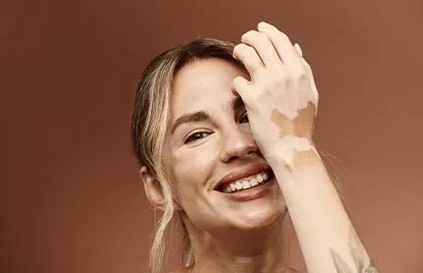 Vitiligo Lekeleri Kalıcı mıdır? Bilimsel Açıdan Değerlendirme