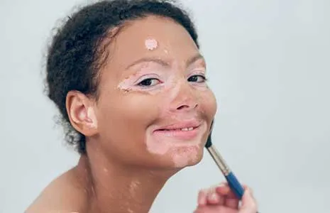 Vitiligo Lekeleri Makyajla Nasıl Kapatılır? Profesyonel Teknikler ve Ürün Önerileri