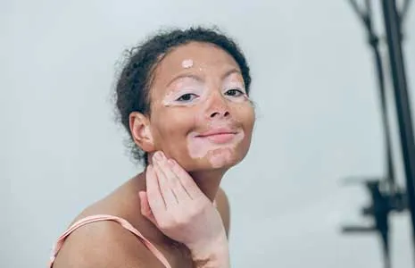 How Is Vitiligo Diagnosed? Tests and Clinical Evaluation