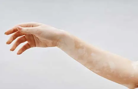 What Are the Most Up-to-Date Treatments for Vitiligo?
