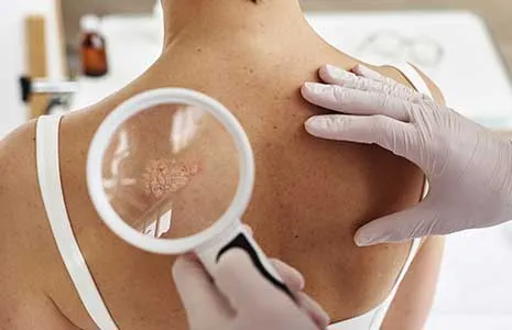 Vitiligo ve Deri Kanseri Riski Arasında Bağlantı Var mı?