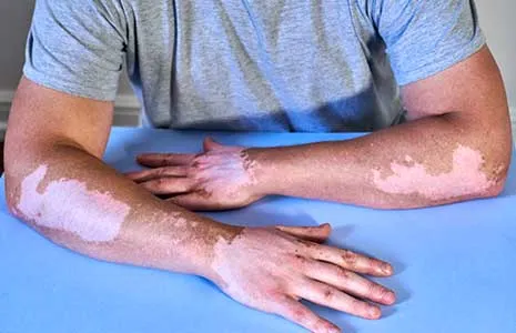 What Is the Relationship Between Vitiligo and Stress?