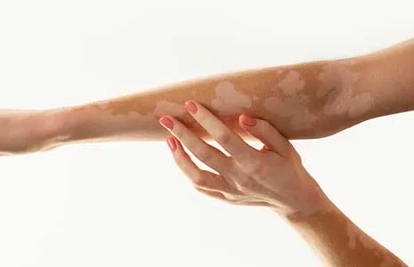 Vitiligo nedir? Belirtileri, nedenleri ve tedavi seçenekleri