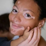 Vitiligo Genetik mi? Aileden Geçiş Olasılığı Hakkında Bilimsel Gerçekler