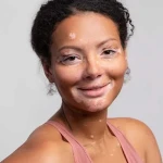 How Should Skin Care Be for Vitiligo Patients?