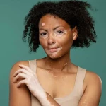 Vitiligo Hastalığında Pigment Hücrelerinin Rolü: Melanositler Nasıl Etkilenir?