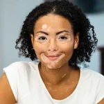 Vitiligo ile Yaşam: Kişisel Deneyimler ve Motivasyonlar