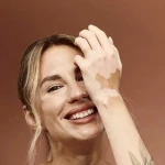 Vitiligo Lekeleri Kalıcı mıdır? Bilimsel Açıdan Değerlendirme
